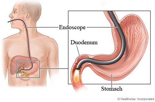 endoscopy_advanced